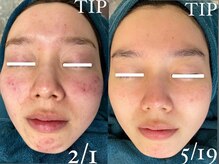 22クラレ(22curare)/最強のニキビケア