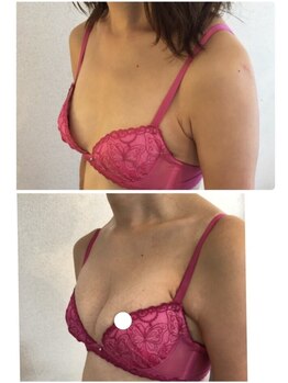 ビューティークリニックコダマ 延岡店/バストアップ《症例》