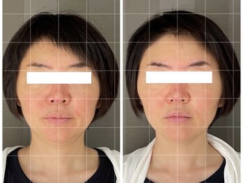 ソルビーフェイス(SOL*BeFace)/ 歪み 頬の出っ張りが悩み