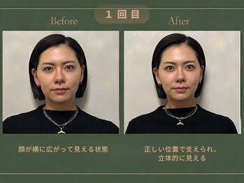 インヤン(yinyang)/30代前半|小顔症例