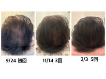 マーブル 熊本合志店の雰囲気（◇施術◇60代男性の施術経過、5回の施術で驚きの効果！）