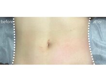 小顔専門店Lift(リフト)新宿三丁目/小顔専門店Lift l 新宿三丁目