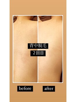 ツリービューティー(Tree Beauty)/before after