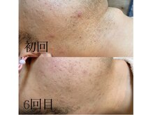 サロン ルーシュ(salon ruche)/脱毛(ひげ)