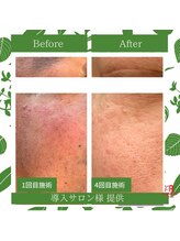 ラプリ 仙台店(Raplit stella)/ハーブピーリング/ニキビケア