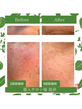 ラプリ 仙台店(Raplit stella)/ハーブピーリング/ニキビケア