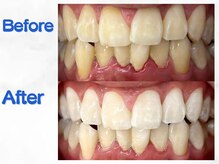 LBSホワイトニング 梅田店/ホワイトニングビフォーアフター