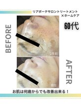 サロン ド フィエルテ(サロン ド・フィエルテ)/60代幹細胞ケア2年の変化