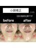 【人気No.2】小顔筋膜ケア 浮腫み解消&肌細胞を活性化  30分￥5000