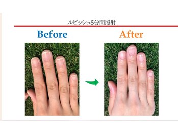 アンテ(Aunte.)/爪だけじゃなく肌も改善☆