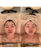 アイビー 二子玉川店(IB)/リフトアップ＆肌質改善☆