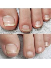 ネイルドール(Nail Doll)/巻き爪ケア