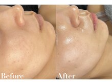 ビジュー(美柔 Bijou)/REVI剥離なしハーブピーリング