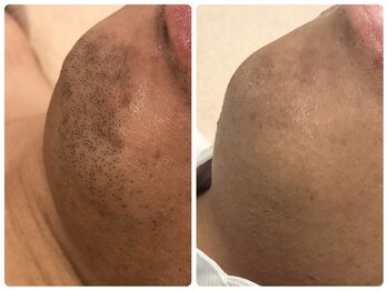 サロンドプレマージュ(Salon de Premage)/メンズ髭脱毛