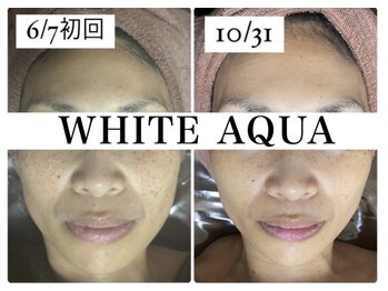 ホワイトアクア 北千住店(WHITE AQUA)/ララピール4ヶ月の変化/シミ改善