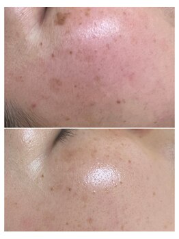 エムクレア(M.clair)/30代女性／シミ症例