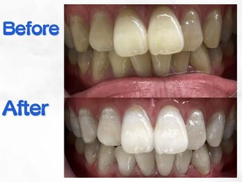 LBSホワイトニング 梅田店/ホワイトニングビフォーアフター