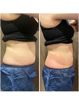 ビュウナ 銀座(BEAUNA)/脂肪冷却/frozen8