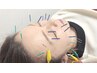 フェイシャル美容鍼灸60分￥5,600→￥2,980
