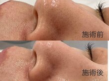 ウェルビーイング(well-being)/毛穴の黒ずみ対策