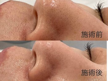 ウェルビーイング(well-being)/毛穴の黒ずみ対策