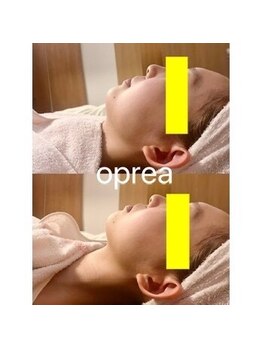 オプレア 栄店(OPREA)/レモンボトル＋小顔コルギ
