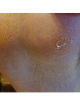 フットケアサロン ラビフット(Rabbi foot)/足裏ガサガサ感気になる方へ