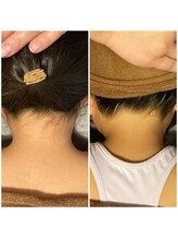 ボンダイボディー(Bondi Body)/キッズうなじ脱毛