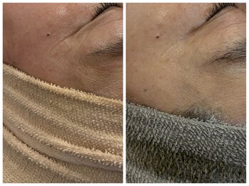 シエル(CieL)/目元のシワケアお任せください