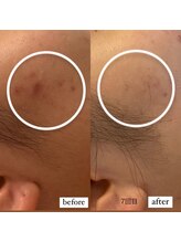 エステティックサロン S/NMNピーリングの効果