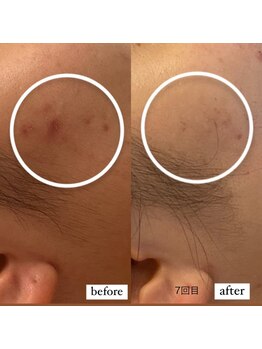 エステティックサロン S/NMNピーリングの効果