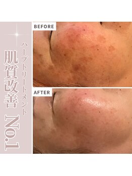 ピーチハート(Peach Heart)/リアボーテハーブトリートメント