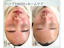 ポノ 茅ヶ崎(Pono.)/湘南/毛穴/ハーブピーリング