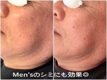 シェアキ(Chez Aki)/シミケアBefore/After