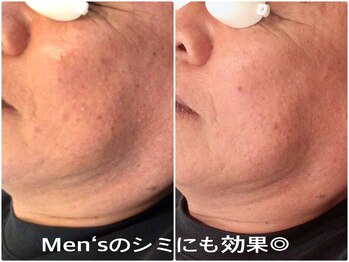 シェアキ(Chez Aki)/シミケアBefore/After