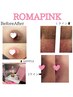 【最新メラニン除去】ローマピンク×期間限定♪各40%オフ/ボディご希望の方☆