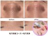 【毛穴改善×毛穴洗浄】頑固な毛穴悩みにはコレ★本気の毛穴レス肌へ¥15500→