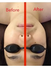 ロジェアムール/小顔リフトアップフェイシャル