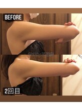 サロン ド 花歩 松山本店/痩せにくい二の腕もこの通り！