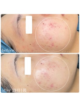 ちらちゅら/乳酸菌＋ハーブピーリング