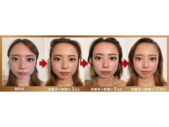 グレースフィオーレ 京橋店(gracefiore)/Before/After( 10回施術)