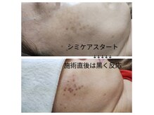 エステの森ジュジュの雰囲気(シミケア直後は黒く反応します♪約5日位で垢となり排出します!!)