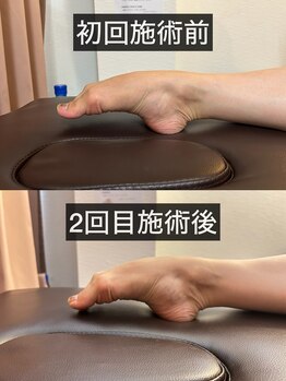 たんぽぽ整骨院鍼灸院/バレエ整体：甲出し