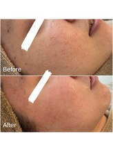 ラヴィアロマティックハーブ 高津 溝の口店(LaviAromaticHerb)/肌質改善