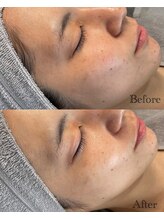 ルシェビューテイー(Luche Beauty)/毛穴撃退コースでスッキリ