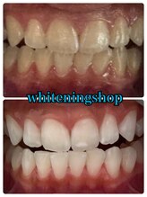 ホワイトニングショップ 山科店/スタッフ10回ビフォーアフター！