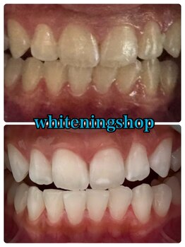 ホワイトニングショップ 山科店/スタッフ10回ビフォーアフター！