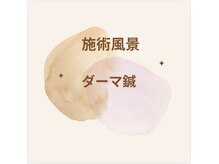 マホロバ(mahoroba)/ダーマ鍼施術風景