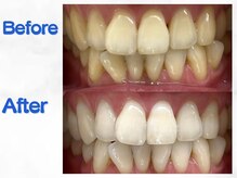 LBSホワイトニング 梅田店/ホワイトニングビフォーアフター
