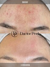 モカラ(MOKARA)&nbsp;ダクト ピール